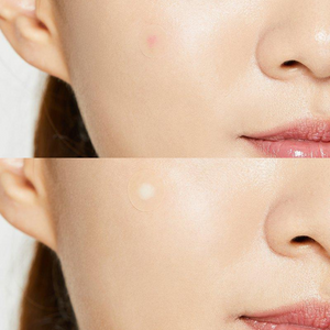 Acne Pimple Master Patch - 1 Sheet